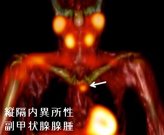 縦隔内異所性副甲状腺腺腫 99m-Tc MIBIシンチグラフィー 縦隔内異所性副甲状腺腺腫 99m-Tc MIBIシンチグラフィー